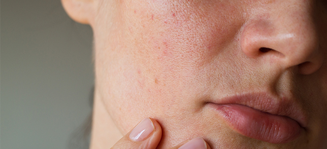 A person feeling slight skin irritation on its cheeks