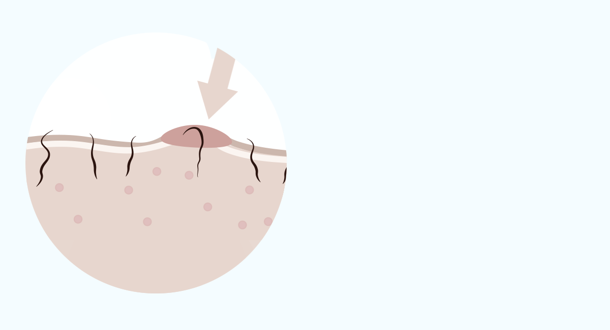 WHAT CAUSES AN INGROWN HAIR?
