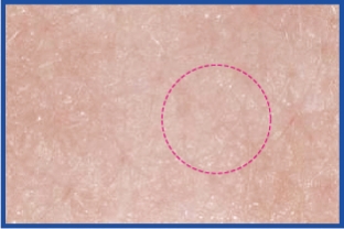 [28 days later] Skin state