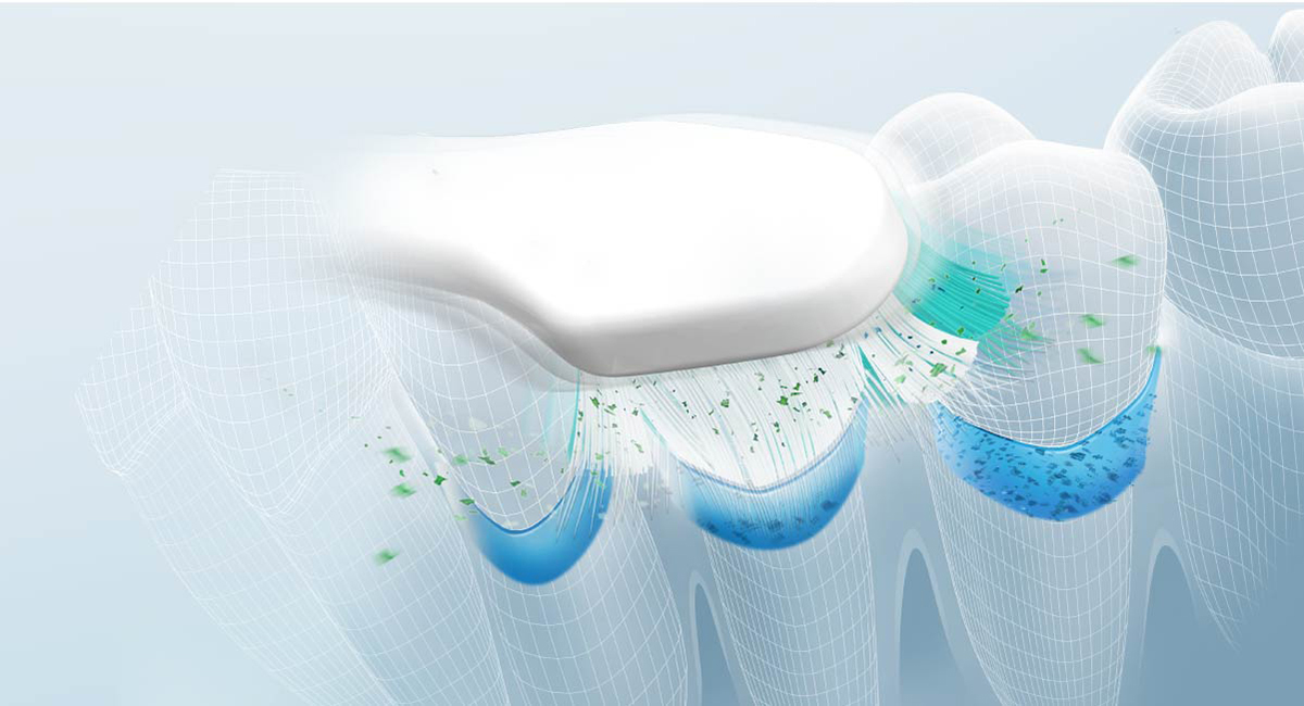 Gumline brushing for removal of plaque in periodontal pockets