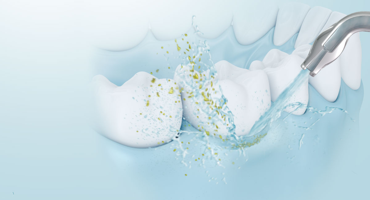 Periodontal PocketCleaning