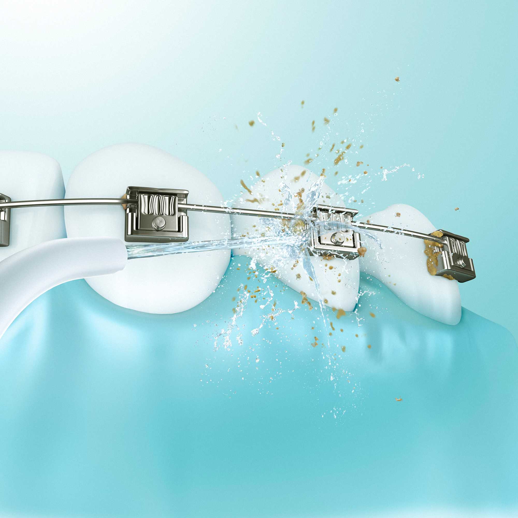 Works around Orthodontic Appliances