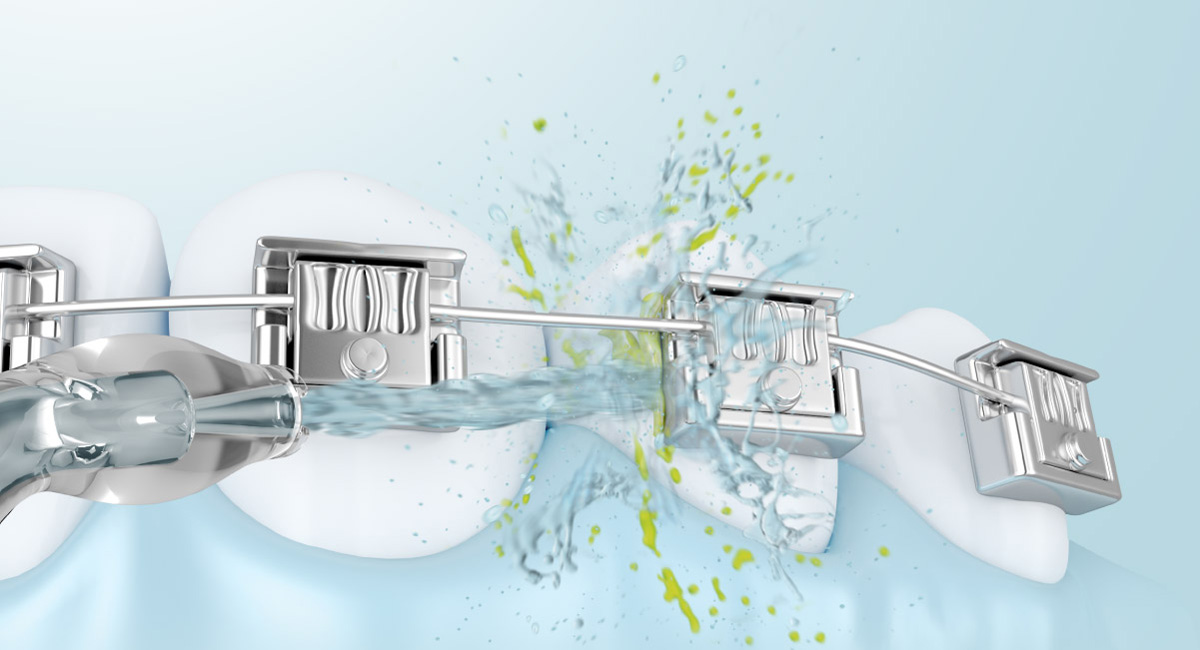 Chăm sóc thiết bị chỉnh nha