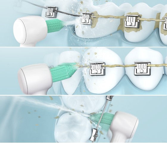 2-in-1-Mundpflege mit Wasserstrahl und Düse mit Bürstenkopf