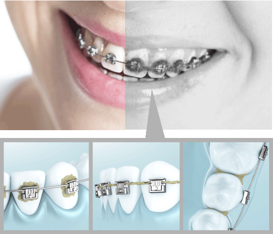 Certains endroits restent inaccessibles au brossage