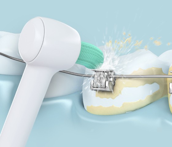 Nouvelle solution d’hygiène bucco-dentaire pour les patients en orthodontie